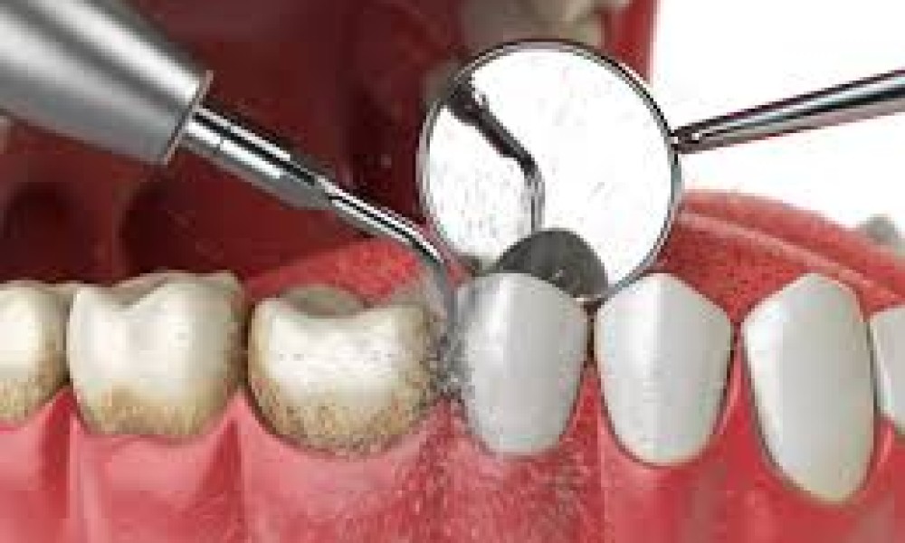Scaling & Polishing (Teeth Cleaning)