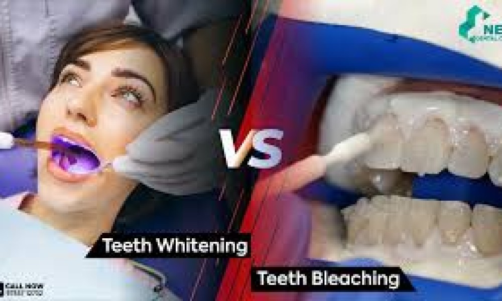 Teeth Whitening / Teeth Bleaching