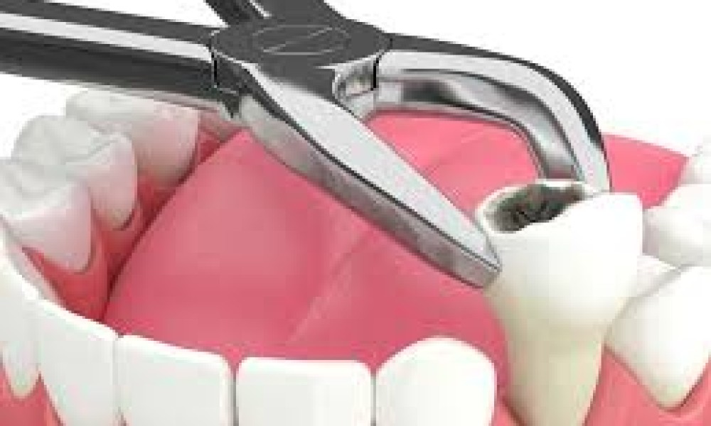 Extractions