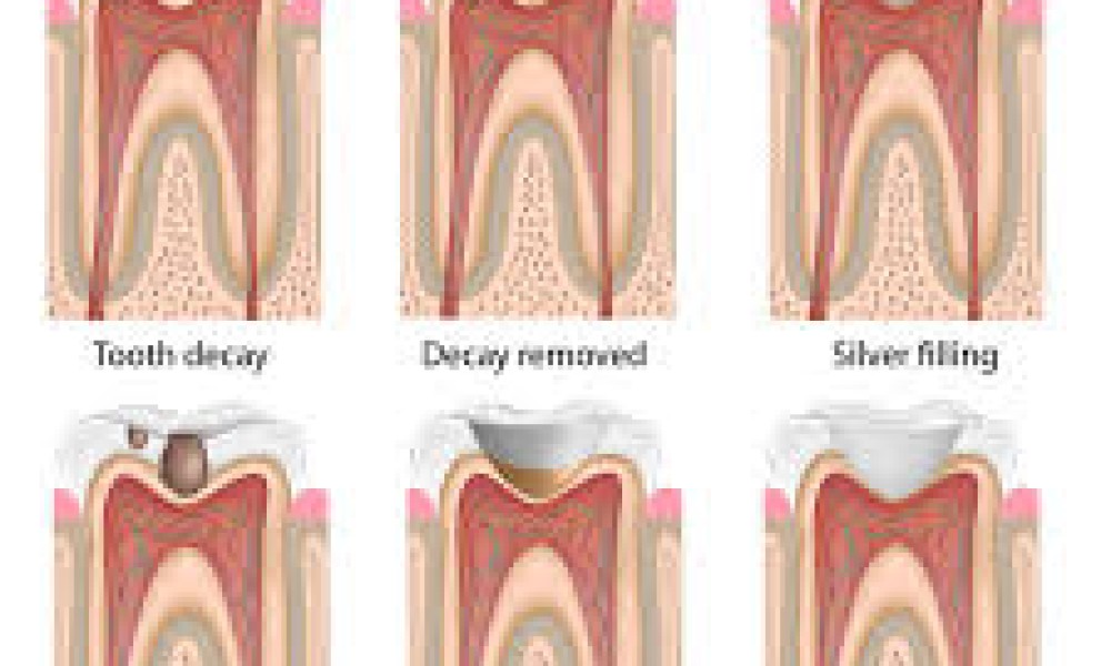 Dental Crowns and Bridges
