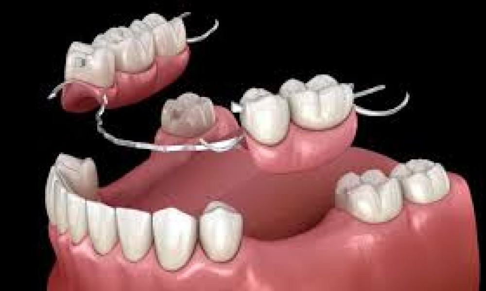 Dentures (Complete and Partials)